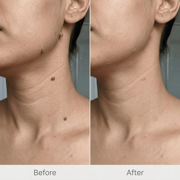 Derma Smooth Spot Corrector – Skin Tag & Mole Remover Patch – alternate view