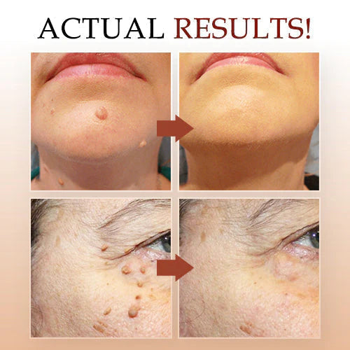 Jaysuing Liquid Wart Remover – Advanced Wart Removal Treatment for Face, Hands & Body - alternate view
