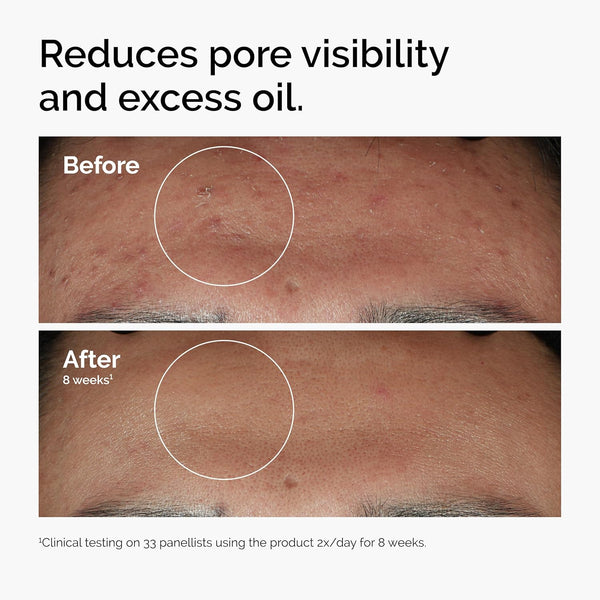 The Ordinary Niacinamide 10% + Zinc 1%, Smoothing Serum for Blemish-Prone Skin - alternate view
